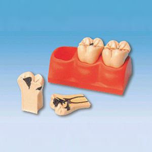 Caries decomposition model